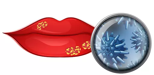 Nguyen-nhan-gay-benh-herpes-la-do-virus-herpes-HSV-1-va-HSV-2